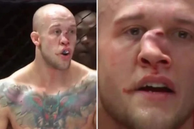 Cenas fortes: lutador sofre fratura grave no nariz após levar joelhada