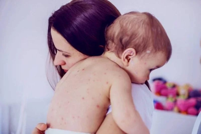 crianca-catapora-primaver-600x400(1)