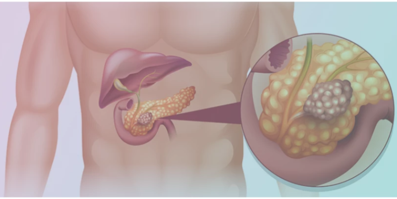 Câncer de Pâncreas b