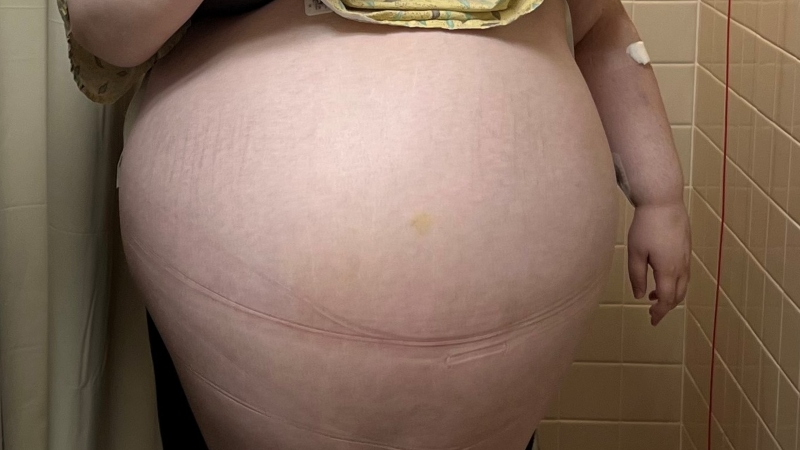 tumor-ovariano-allison-fisher (1)