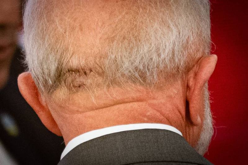 Pontos-na-cabeca-do-presidente-Lula