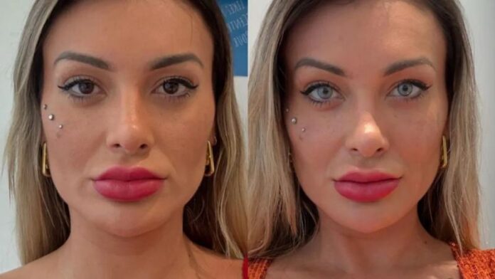 antes-e-depois-andressa-urach