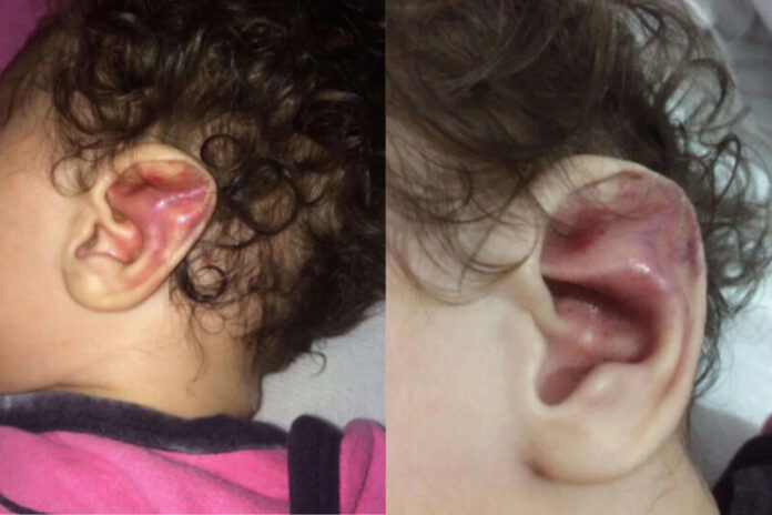 Bebe-de-6-meses-apresentava-lesoes-e-fraturas-graves