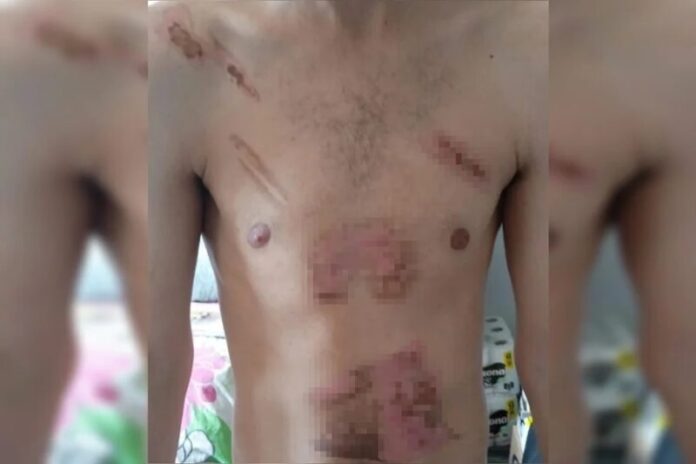 Jovem é torturado, queimado com ferro e chapinha de cabelo por mulher