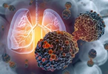 Câncer de pulmão: o tumor mais incidente globalmente, com desafios no diagnóstico precoce